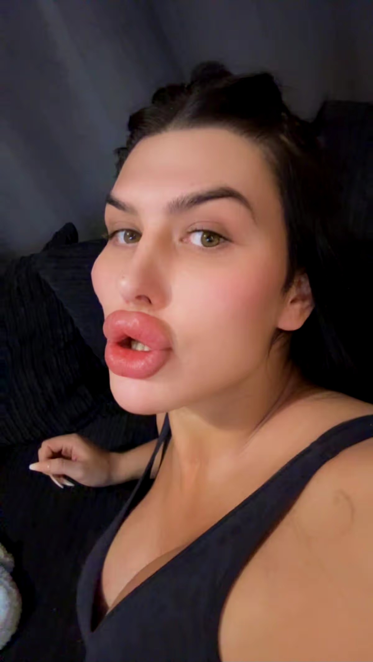 Sofia's appearance after fillers were dissolved