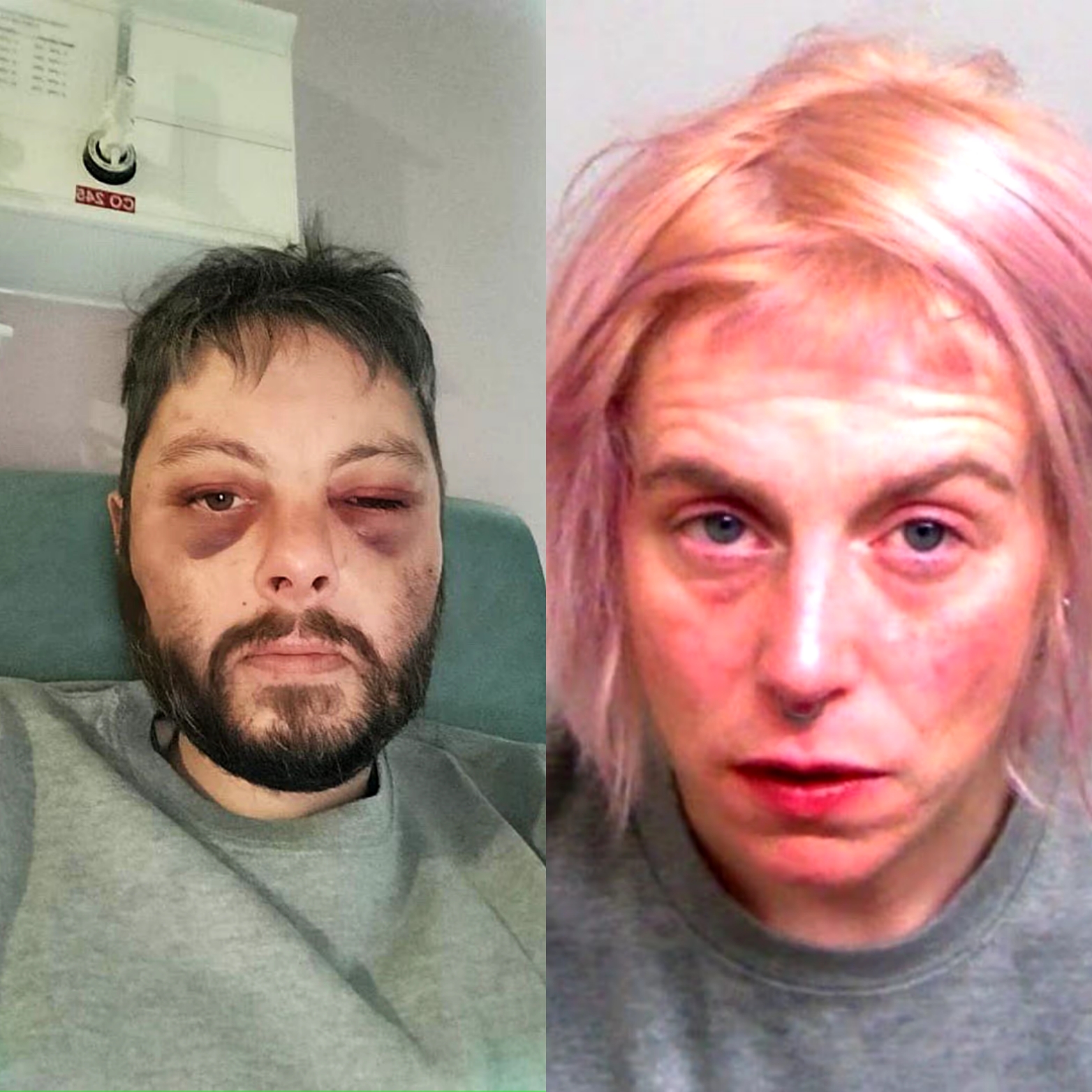 James Self showing severe bruises after the attack by Polly Murphy