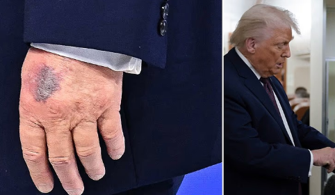 President Trump with a bruise on his hand