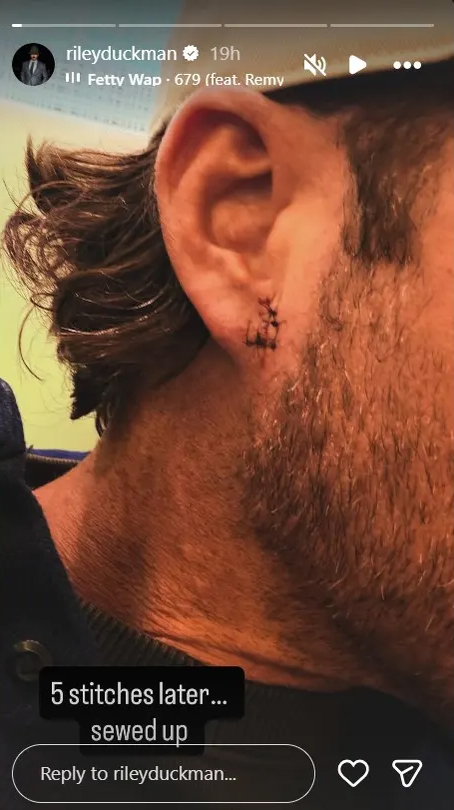 Injury sustained by Riley Green with stitches.